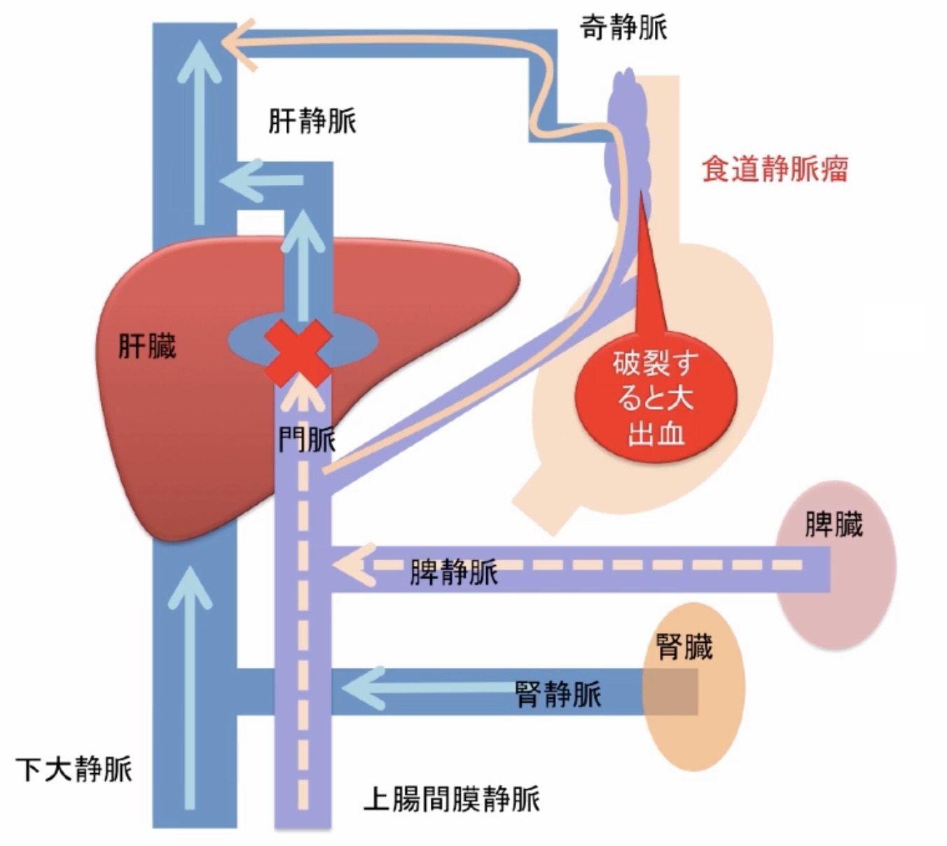 食道静脈瘤破裂に対する薬物療法とは? やまDブログ 食道静脈瘤破裂に対する薬物療法とは? やまDブログ